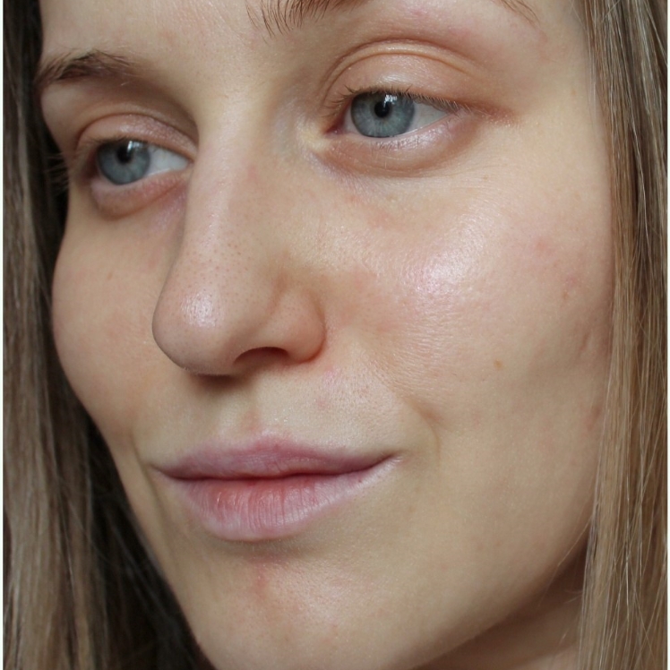 Lily before dermatica anti-ageing treatment